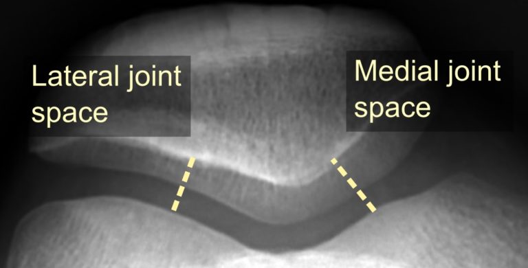 Basic Anatomy of the Patellofemoral Joint | Knee Pain Info